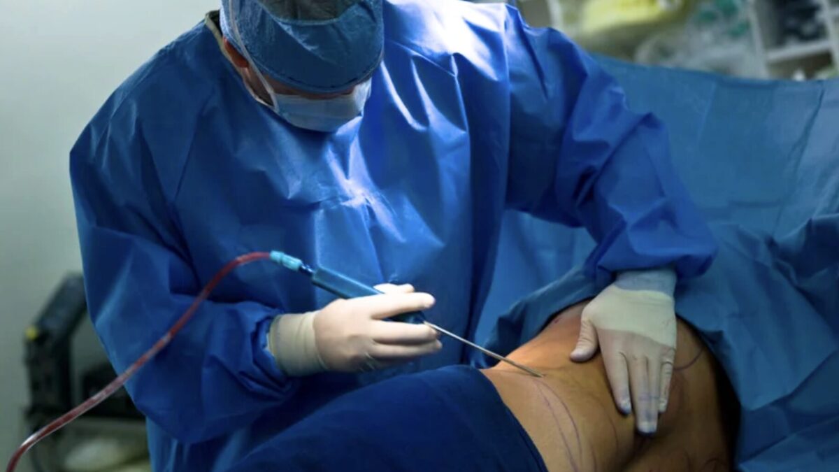 Liposuktion bei Lipödem