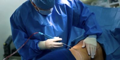 Liposuktion bei Lipödem