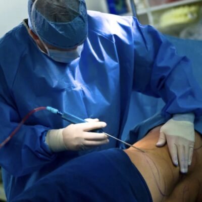 Liposuktion bei Lipödem