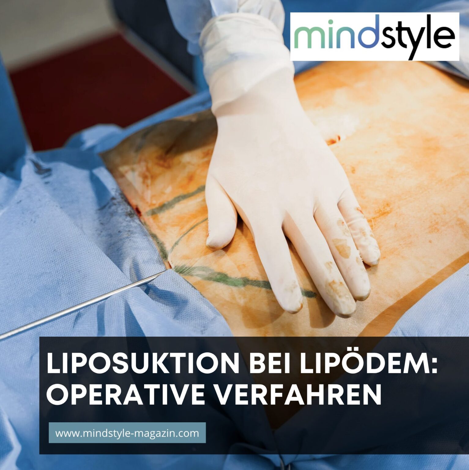 Luxus Entwssern Nach Liposuktion Bild