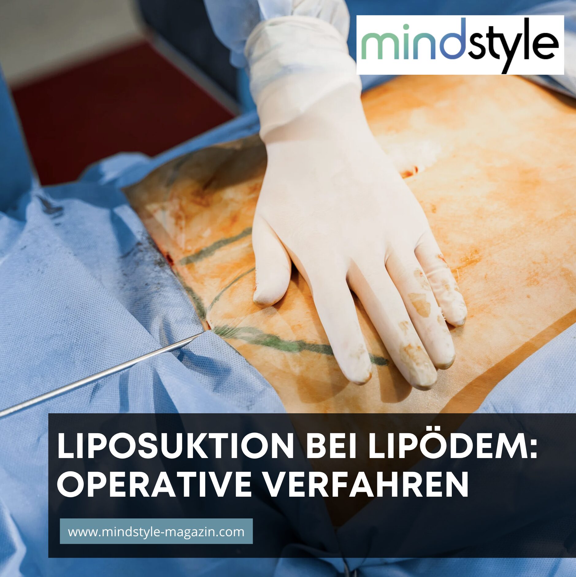 Liposuktion bei Lipödem: Operative Verfahren Liposuktion bei Lipödem: Operative Verfahren