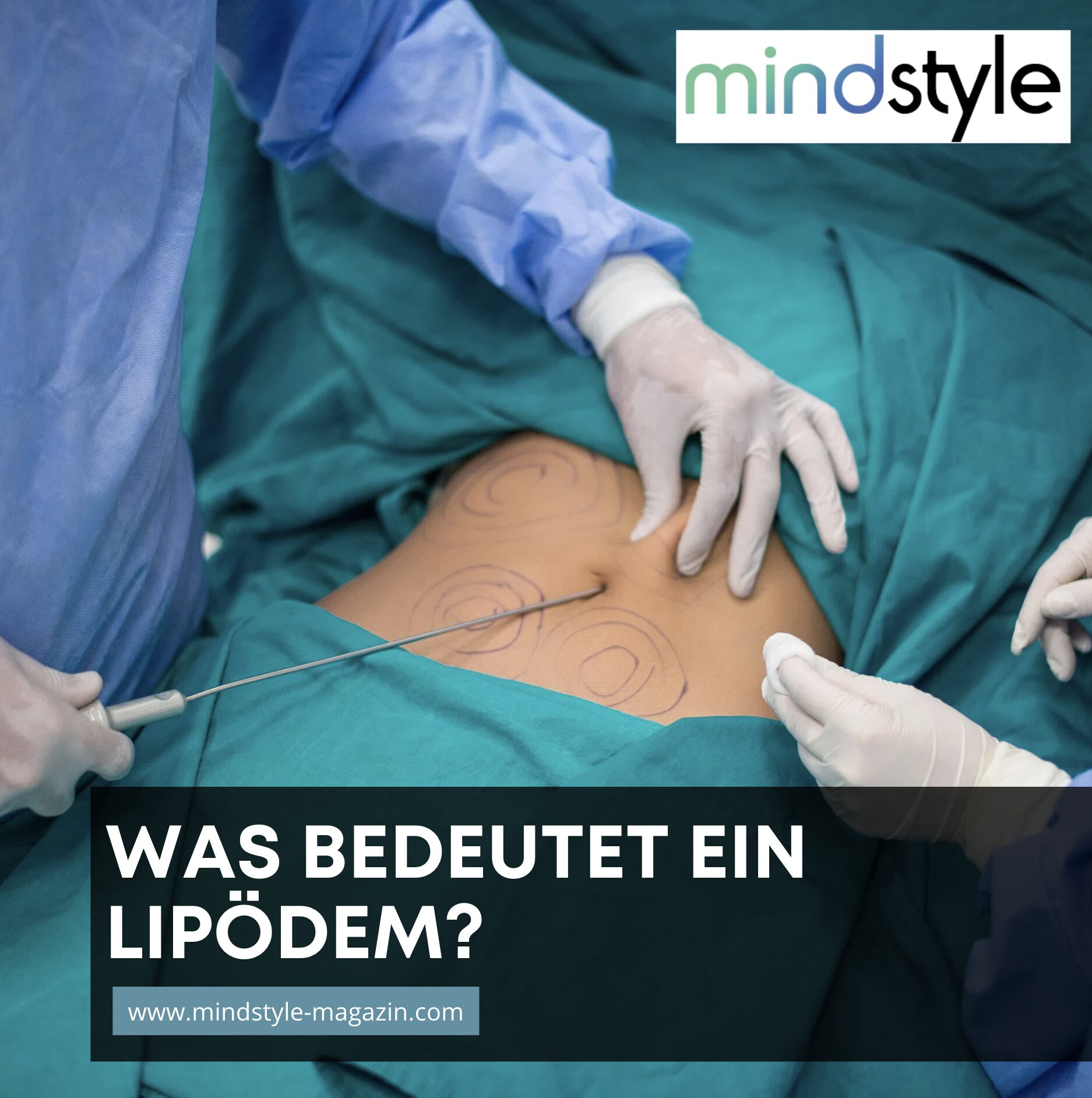 Was bedeutet ein Lipödem? Was bedeutet ein Lipödem?